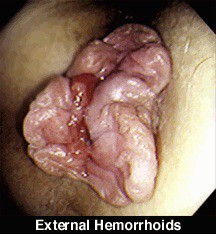 Vonkajšie hemoroidy
