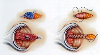 Fergusonova hemoroidektomia