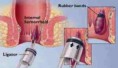 /album/fotogaleria/hemorrhoid-banding-procedure-and-treatment-jpg/
